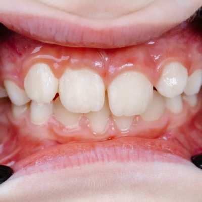 Crossbite