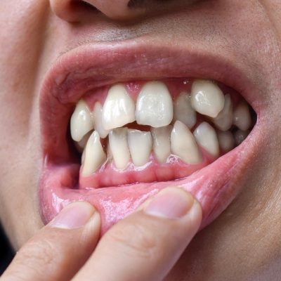 Crowded teeth