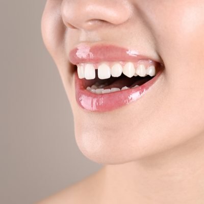 Gaps between teeth