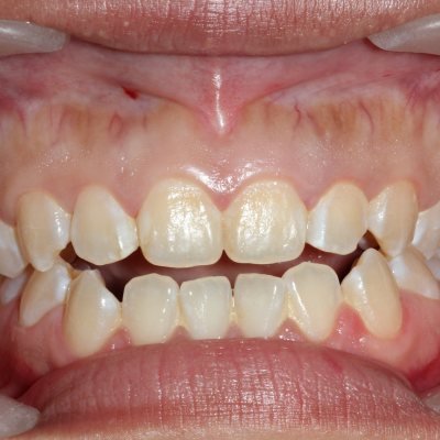 Open bite