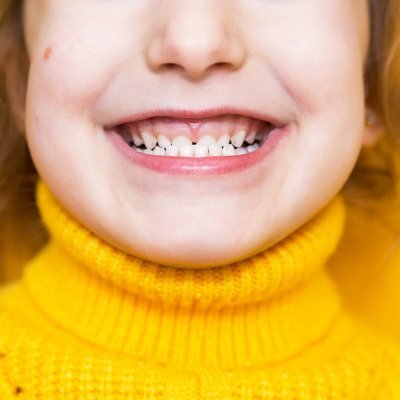 Overbite