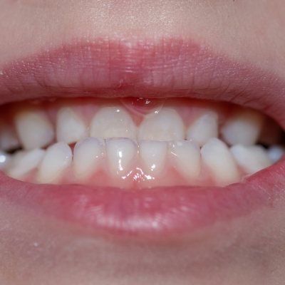 Underbite